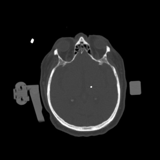 1.25mm Deep Brain Stimulation  Bone Window 1 Electrode-2