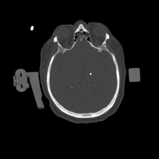 1.25mm Deep Brain Stimulation  Bone Window 1 Electrode-3