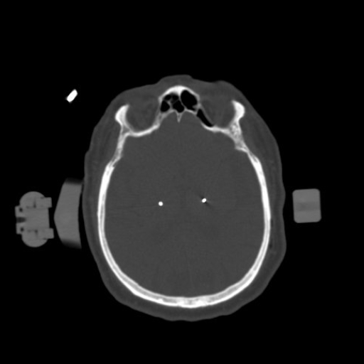 1.25mm Deep Brain Stimulation  Bone Window 2 Electrodes-2