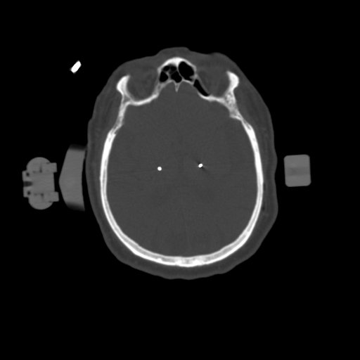 1.25mm Deep Brain Stimulation  Bone Window 2 Electrodes-3