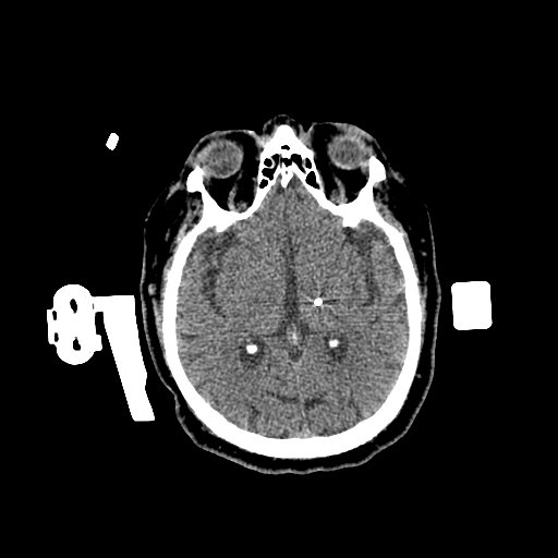 1.25mm Deep Brain Stimulation  Brain Window 1 Electrodes-2