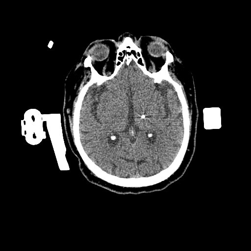 1.25mm Deep Brain Stimulation  Brain Window 1 Electrodes-3