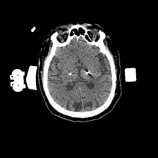 1.25mm Deep Brain Stimulation  Brain Window 2 Electrodes-2