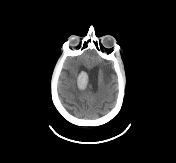 Adult Brain 1b