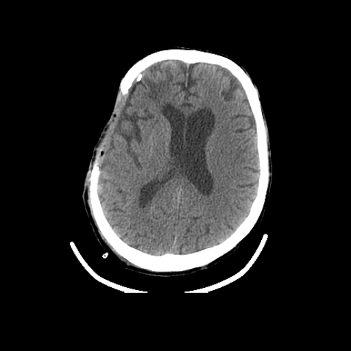 Adult Post Surgical Craniotomy-1