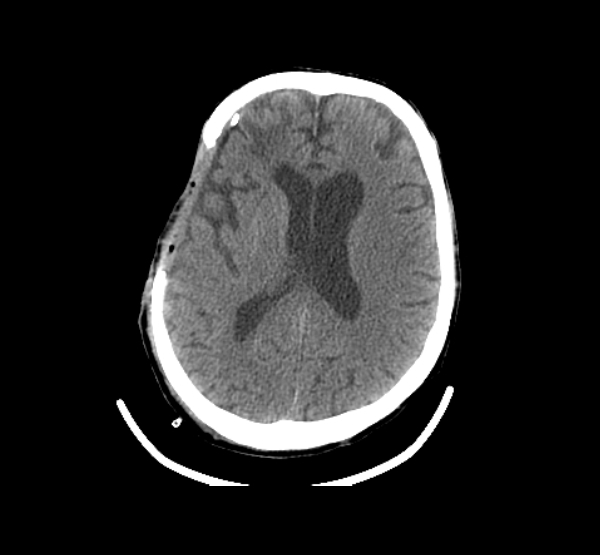 Adult Post Surgical Craniotomy-2