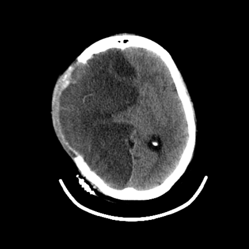 Axial Brain-1