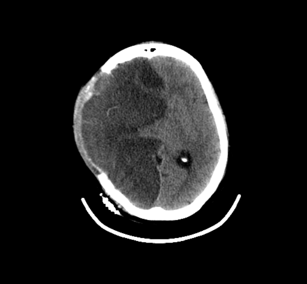 Axial Brain-2