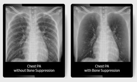 Bone suppression-1