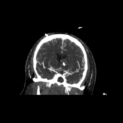 CereTom CTA Coronal image