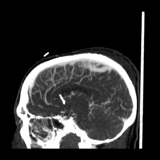 CereTom CTA Sagittal image