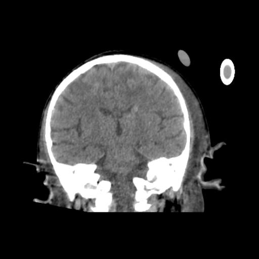 CereTom Pediatric A Coronal Brain