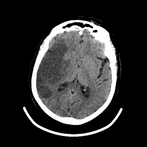 CereTom Stroke A image 3