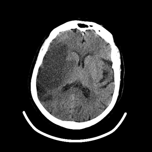 CereTom Stroke A image 4