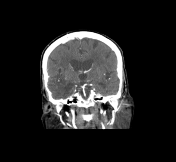 Coronal CTA