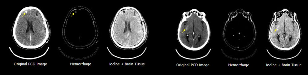 Hemorrhage vs Iodine-1