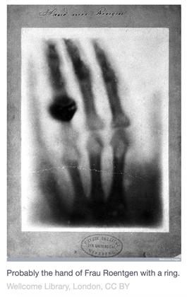 hand-ring-xray