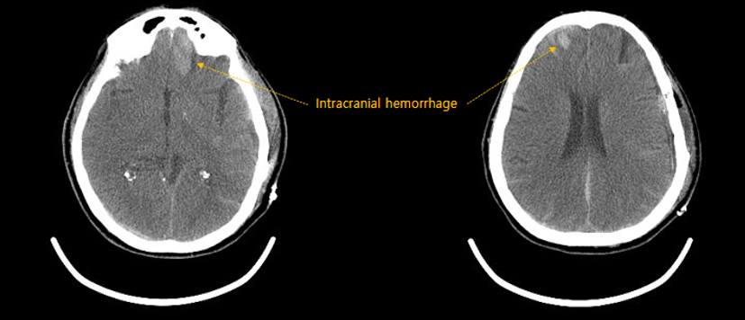 Intracranial hemorrhage without label
