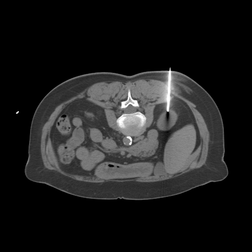 Kidney Biopsy-1