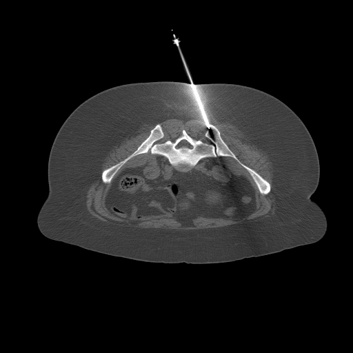 Left Iliac Wing Biopsy