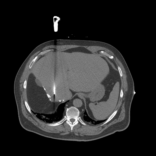 Liver Ablation-1