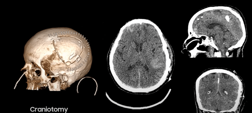 Neuro ICU Patient - Intracerebral Hemorrhage - without label-1