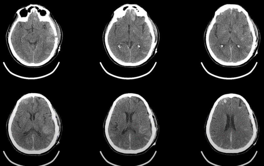Neuro ICU Patient - Intracerebral Hemorrhage2 - without label