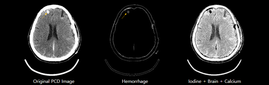 Original PCD - Hemorrhage - Iodine-Brain-Calcium without label