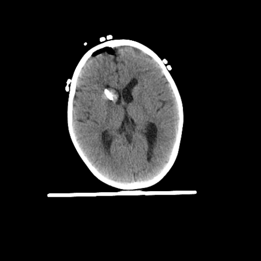 Pediatric 4 yo Brain-3