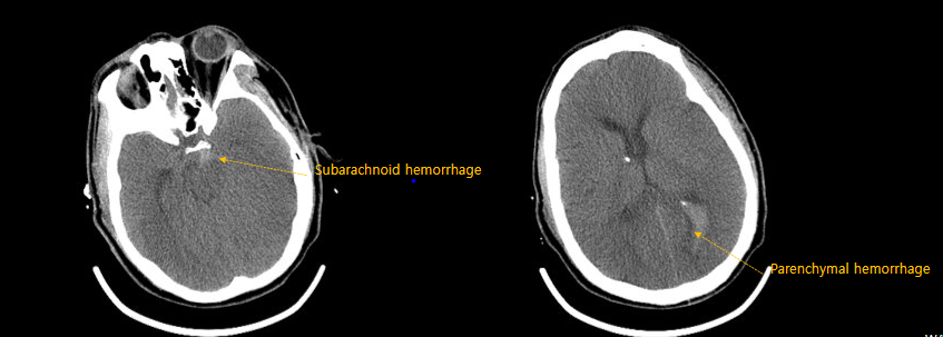 Subarachnoid hemorrhage vs parenchymal hemorrhage