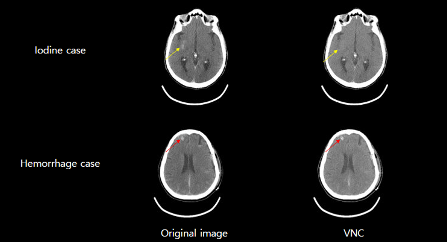 VNC (Virtual non-contrast) - without label
