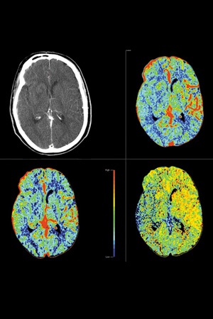 Perfusion Color Maps