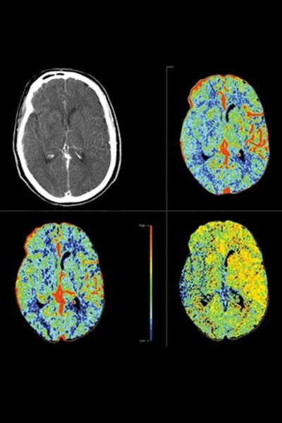 Perfusion Color Maps