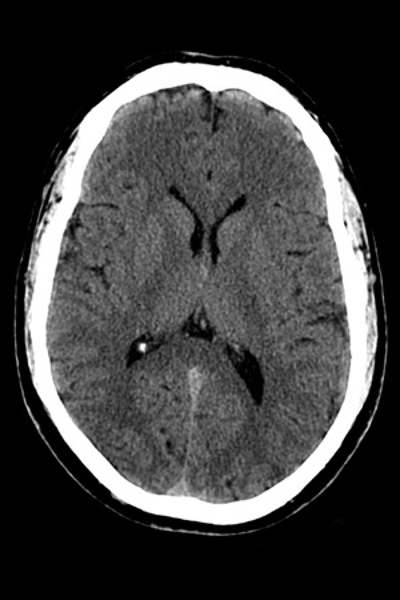 Standard Brain