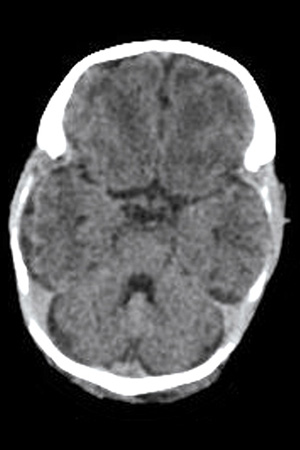 Neonate Brain