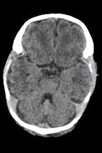 Neonate Brain