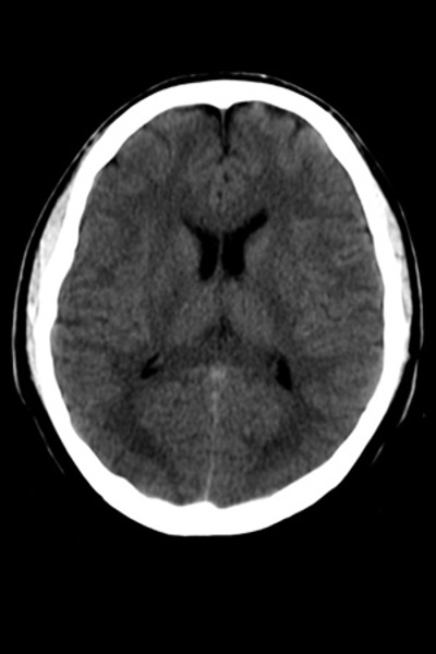 Pediatric Brain