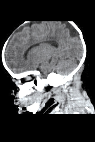 Sagittal Brain