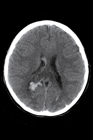 Subdural Bleed