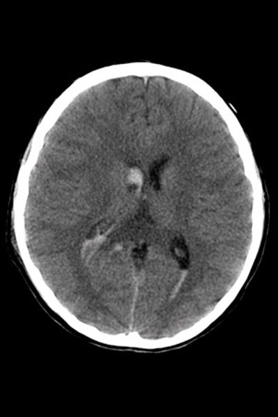 Ventricular Bleed