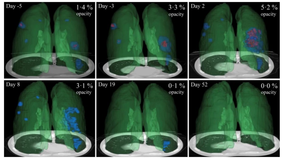 Progression of CT scans of Covid patient over 2 months