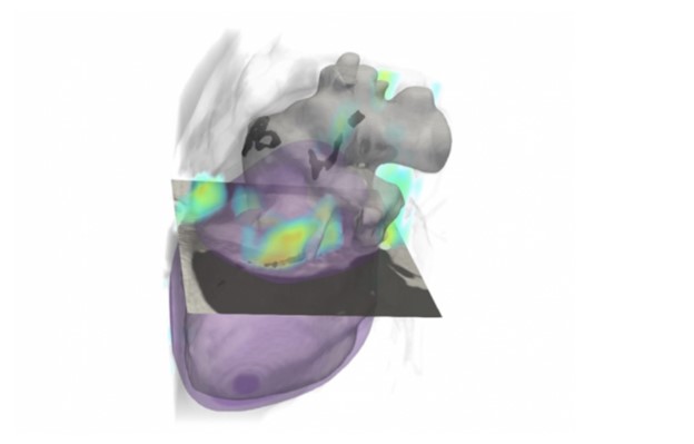 CT image of a heart