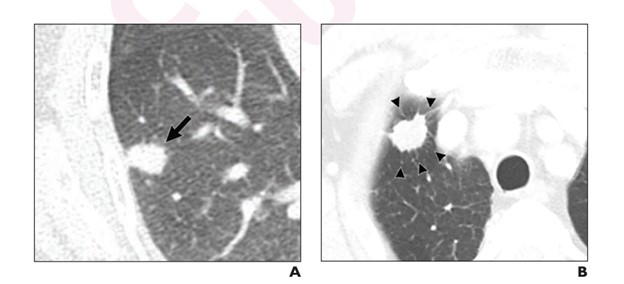 lymphovascular-invasion-ct