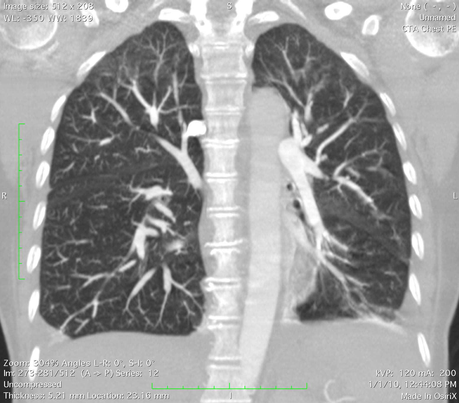 Lung_Contrast_PE_study_MIP_Slab