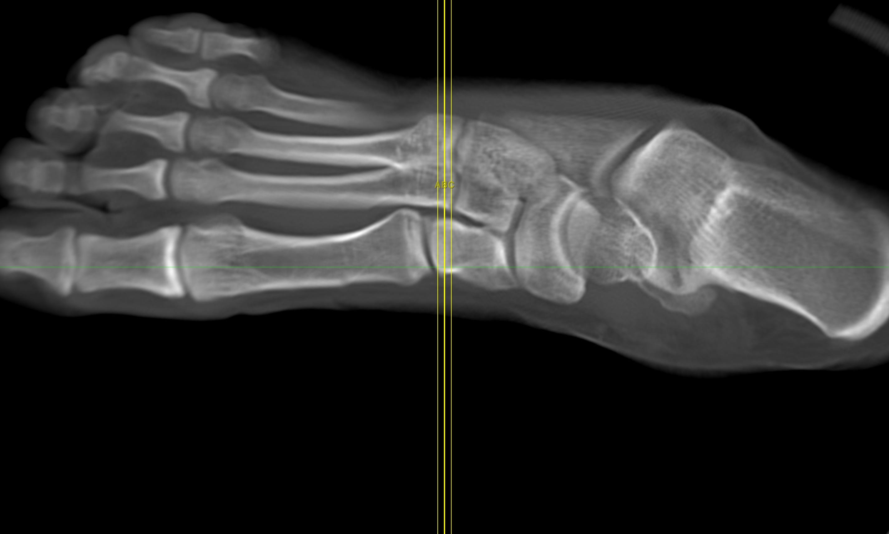 Curved MPR Image - Foot - 15mm