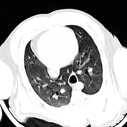 Primate Lung with Contrast
