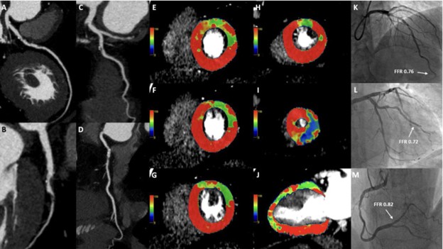 CT image of a heart