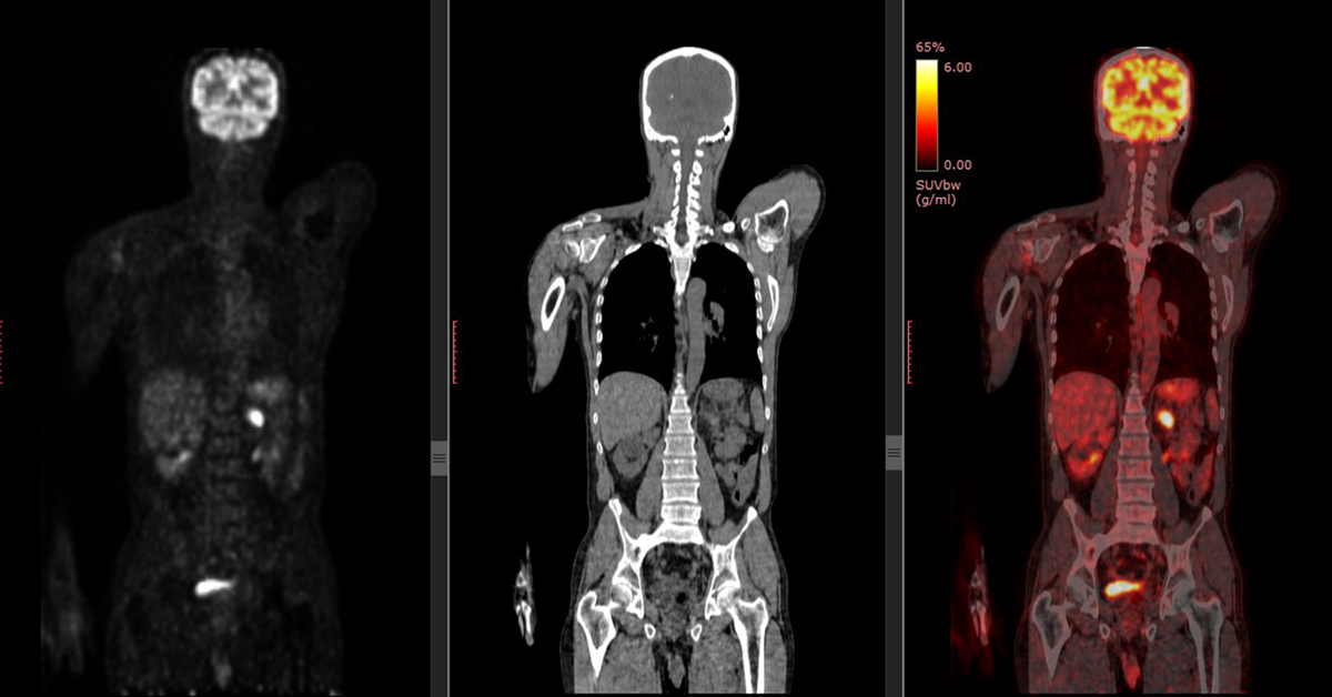 What is a PET vs CAT scan?